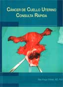 Cáncer de cuello uterino. Consulta rápida